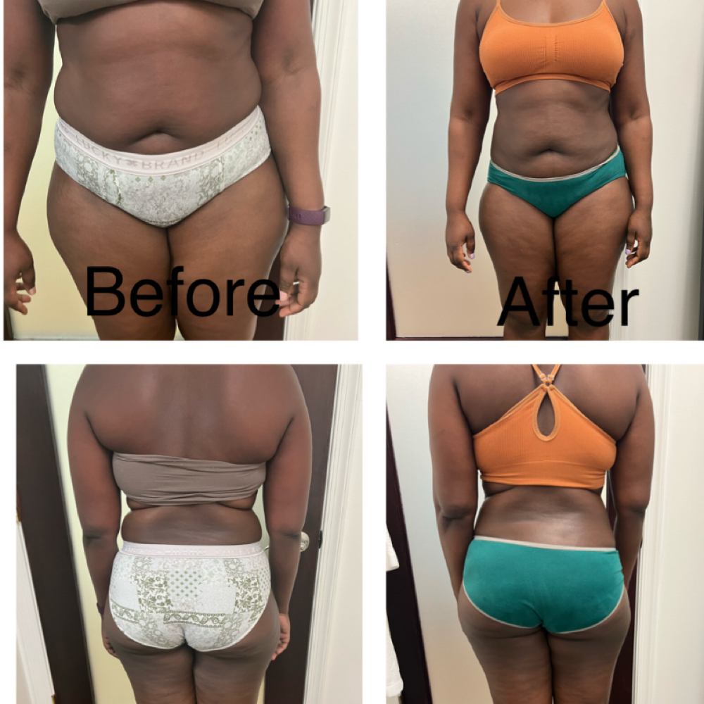 Sculpting & Smooth Package at Demure Skin and Body Sculpting in Columbia, MD