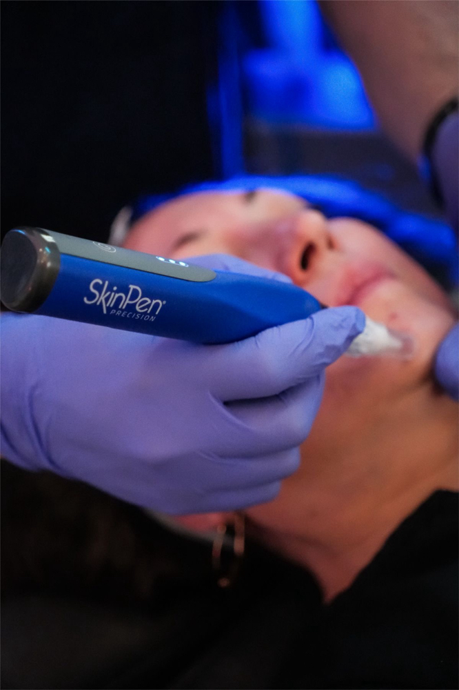 Microneedling + Facial Profundo