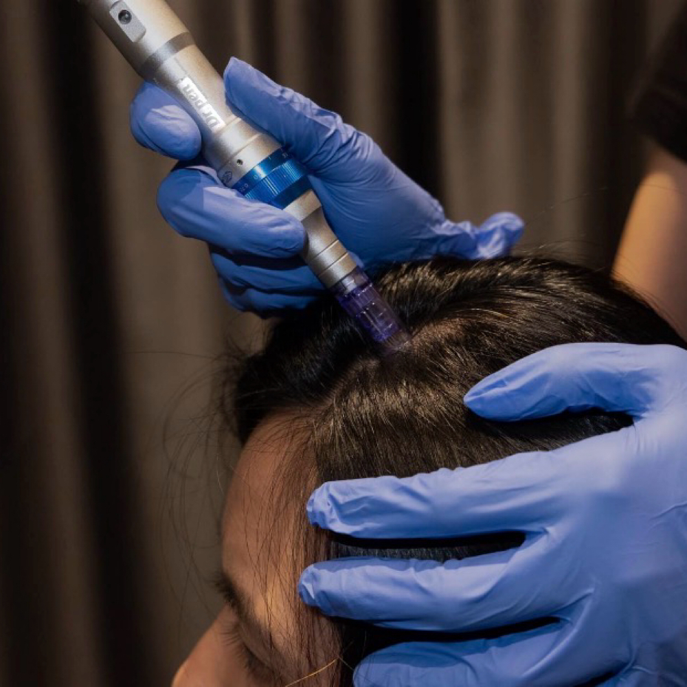 Scalp PRP & Microneedling at Spatium Urgent Care & Wellness in Marietta, GA