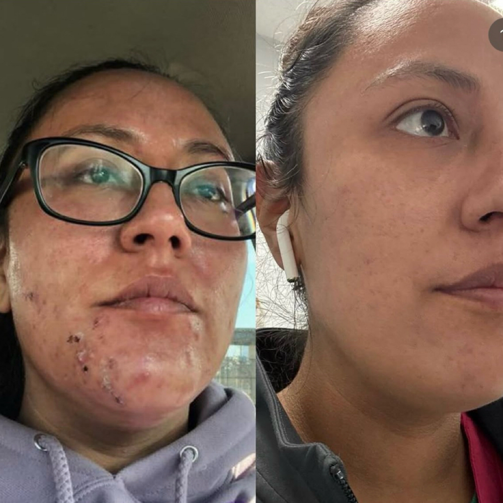 Acne Consultation (Online/Offline) at Beauty Zone by Tetiana Cherepaka in Chicago, IL