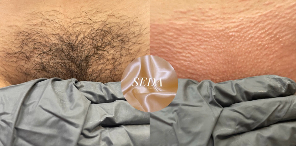 Brazilian Wax