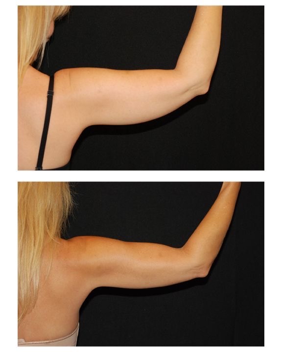 Body Sculpt (ARMS)