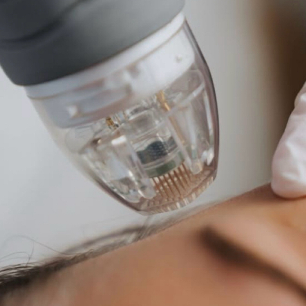 RADIO FREQUENCY MICRONEEDLING at NICHÉ in Lewisville, TX
