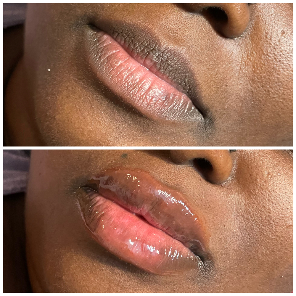 Needleless Filler 1st Syringe