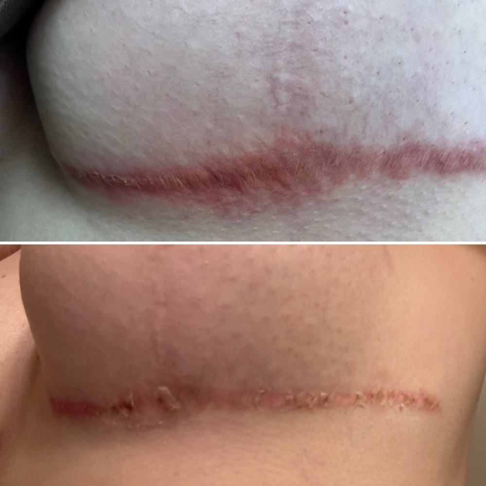 Scar Reduction Consult