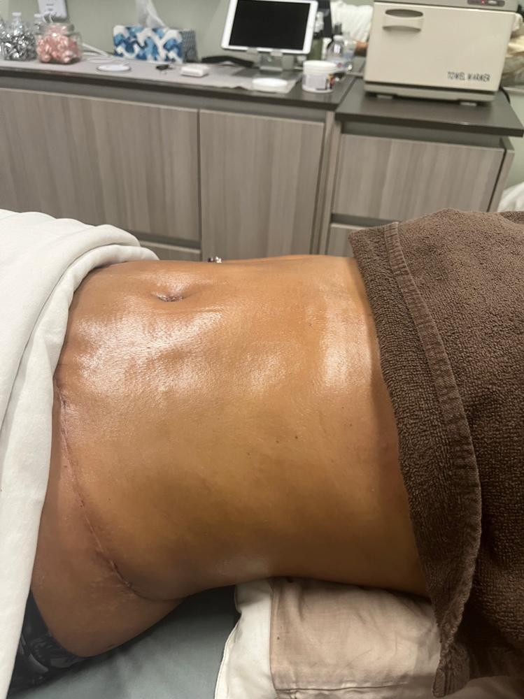 POST SURGERY LYMPHATIC DRAINAGE