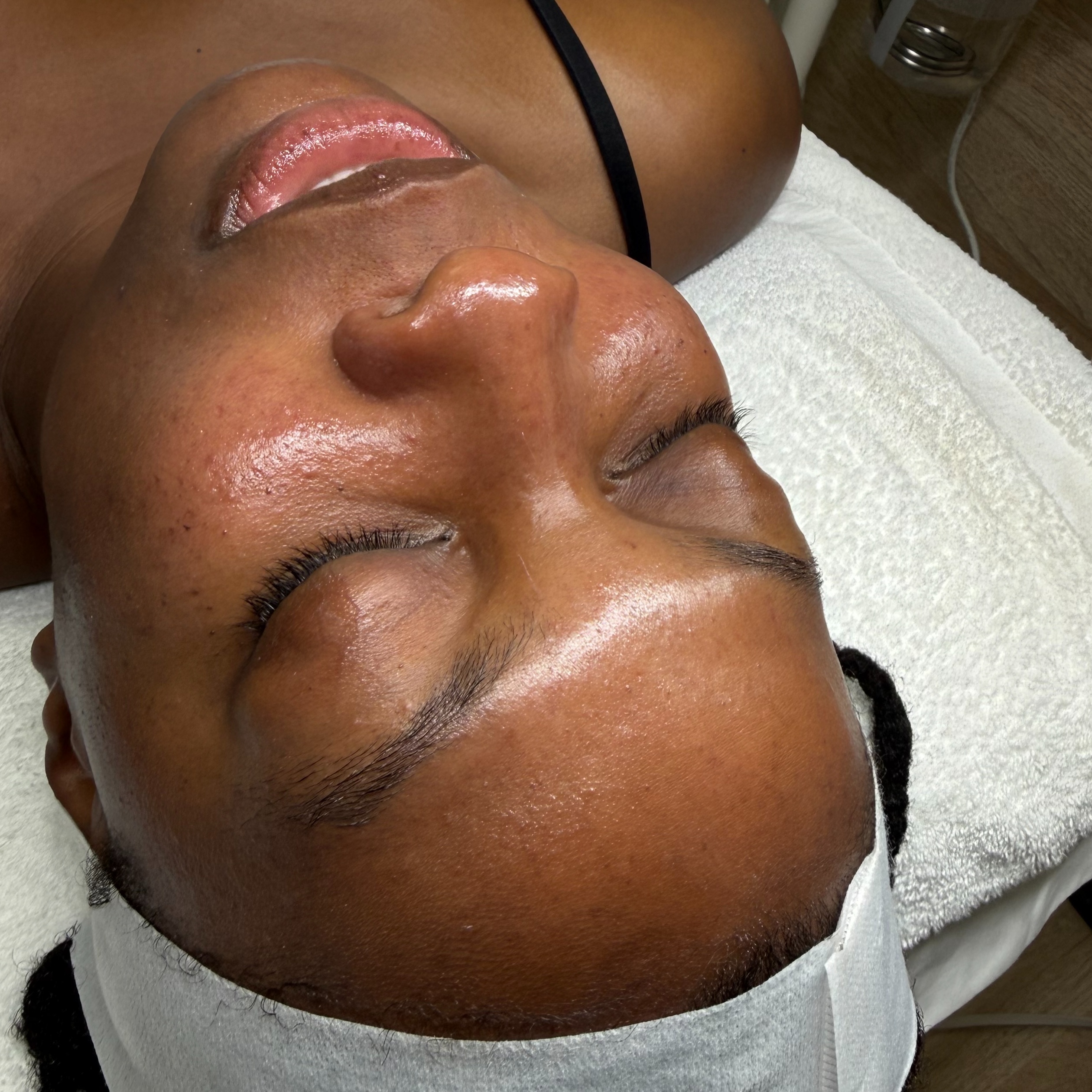 Collagen Renewal Therapy at Velnaira in Lakewood, CA