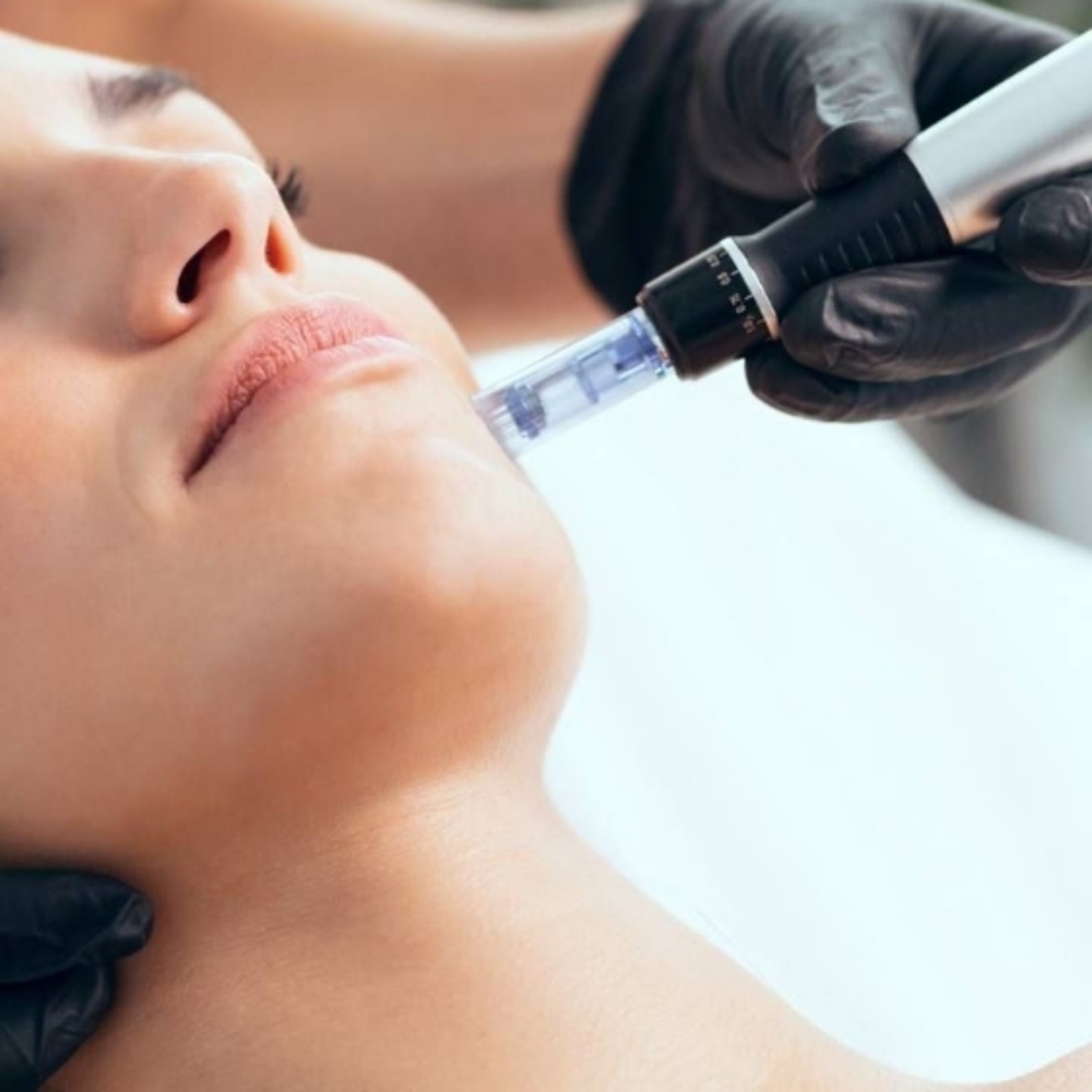 RAE Renewal Microneedling Facial at RAE Wellness in New Bern, NC