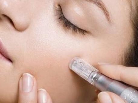 Microneedling