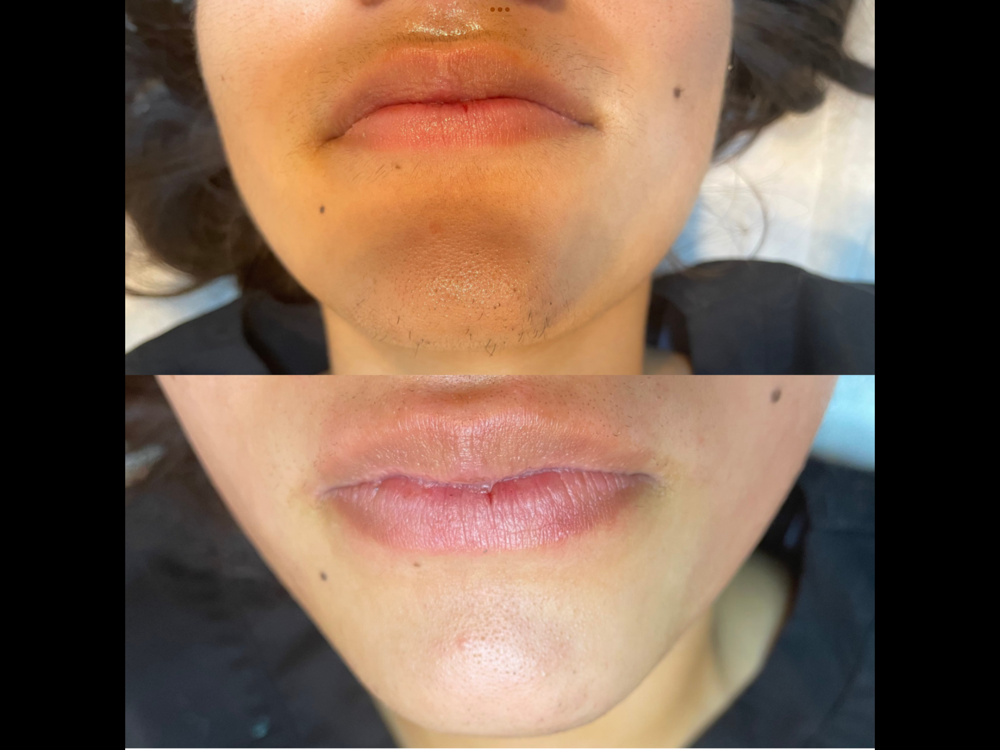 Chin Wax