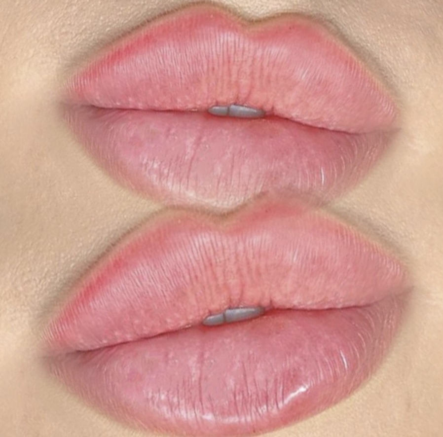 Bring A Friend Lip Filler