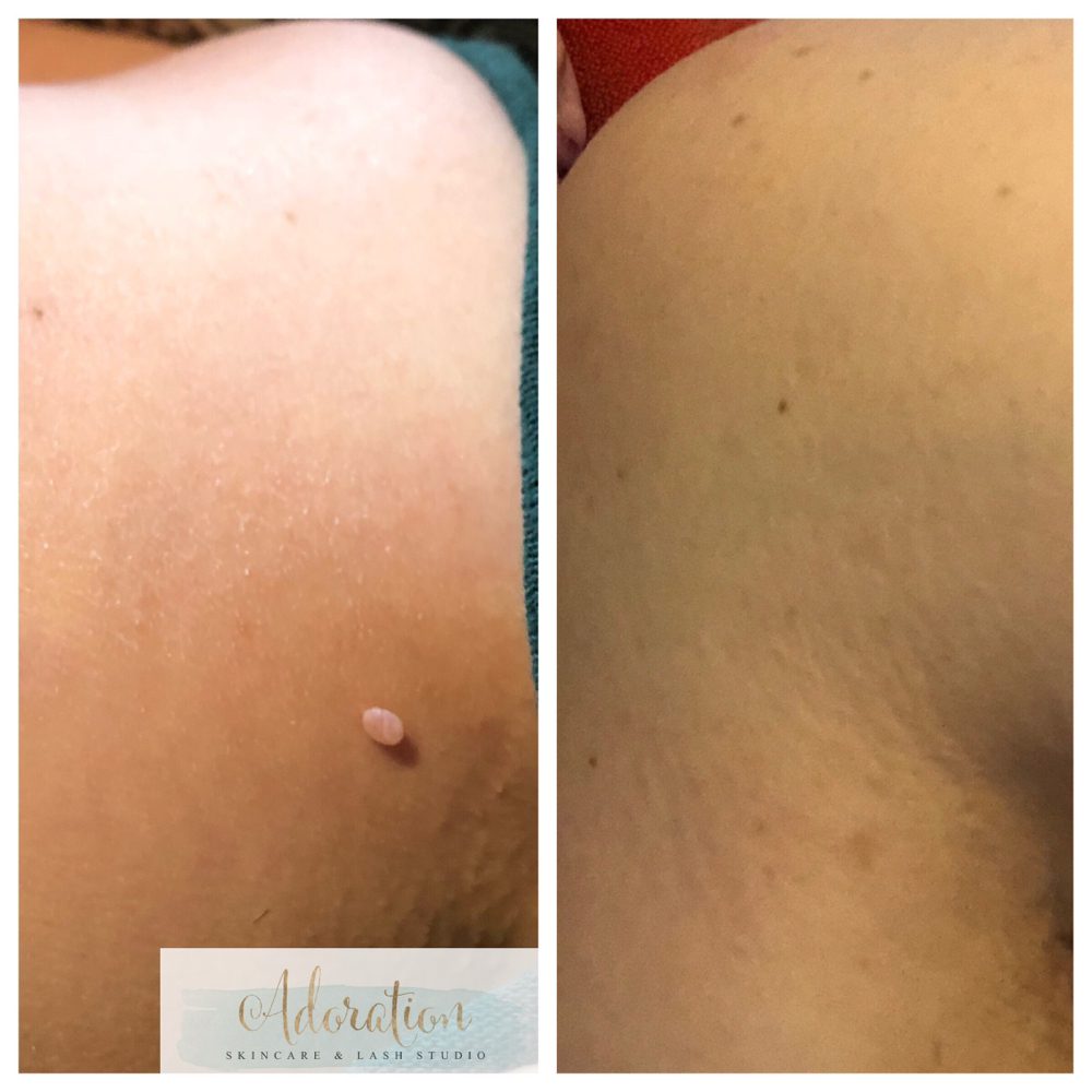 Skin Classic Treatment