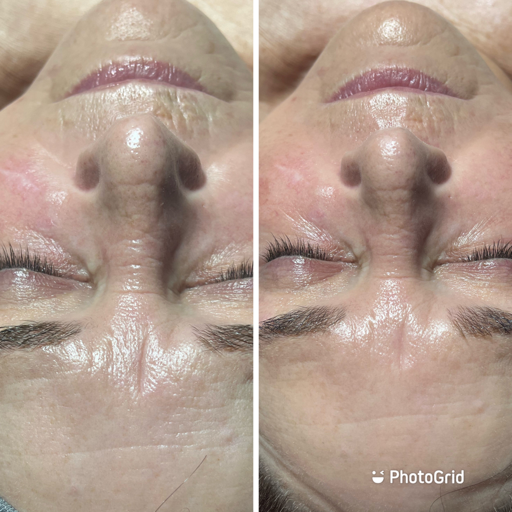 Dark Spot Treatment