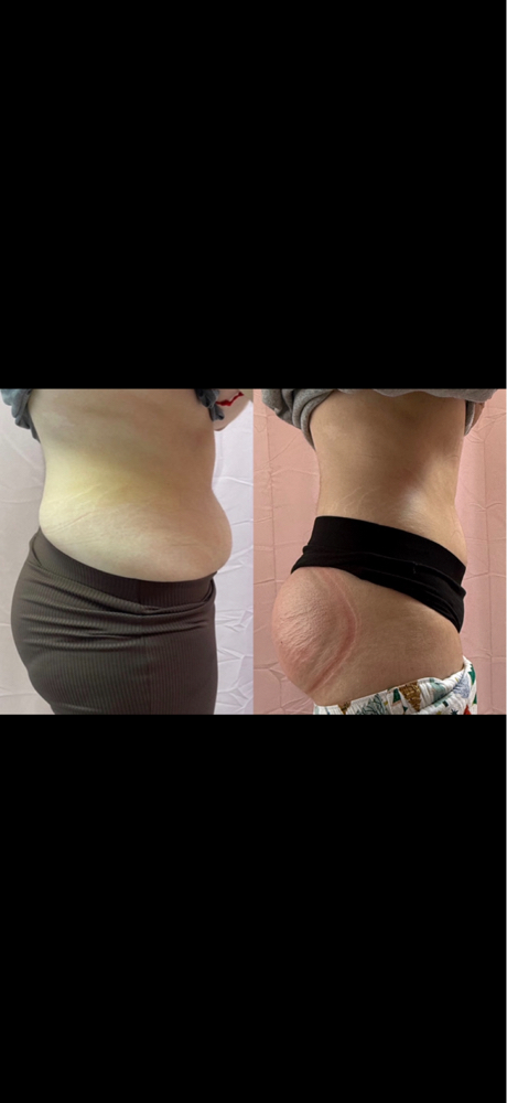 Sculpt Me All Duo (Contoure + BBL)