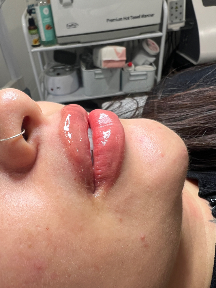Lips Fillers Hyaluronic