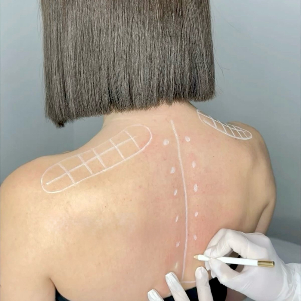 Trap Tox - Shoulder & Neck Tension