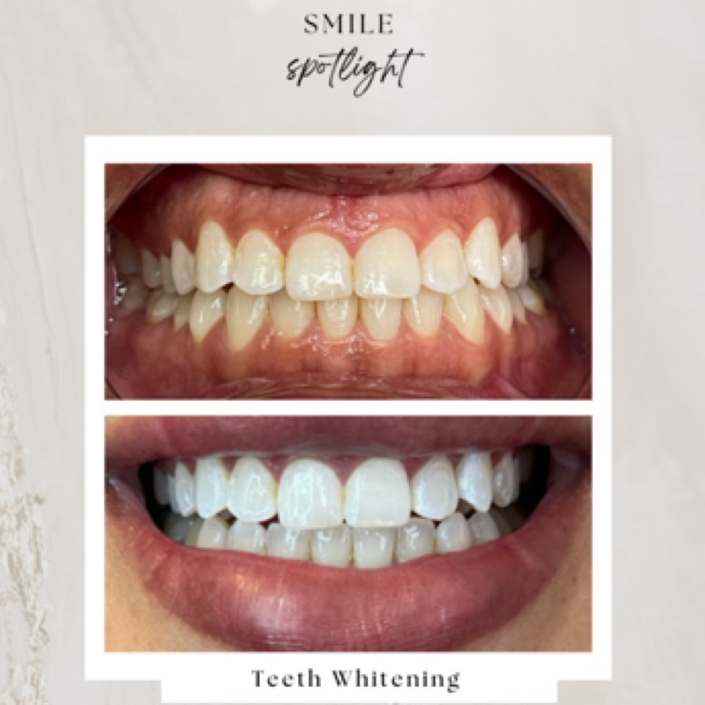 Teeth Whitening at LashBeautyBar954 in oakland park, FL