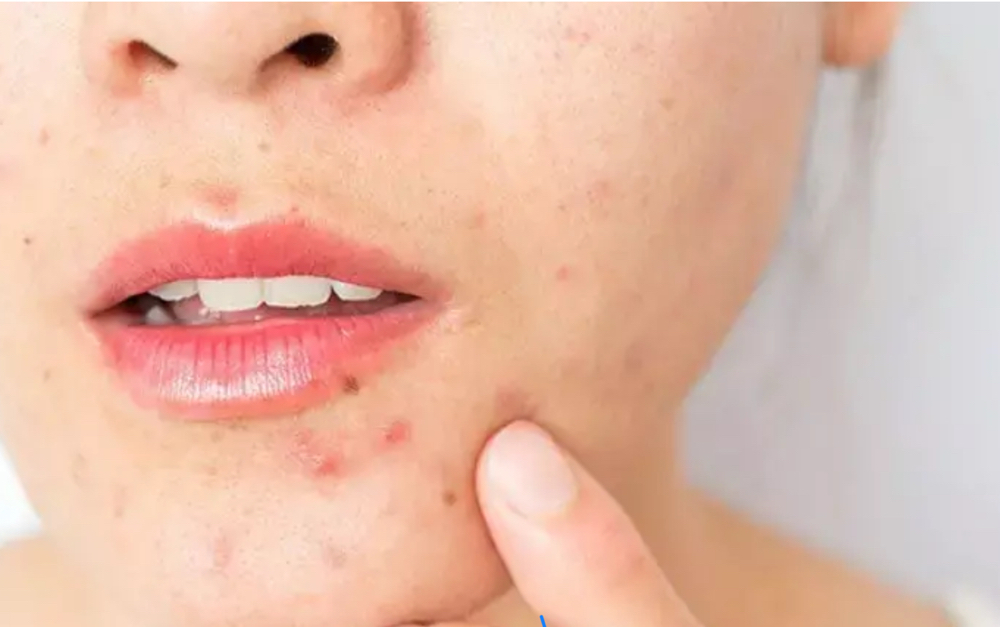 Acne Peel at Faces by DeAngela in New Brockton, AL