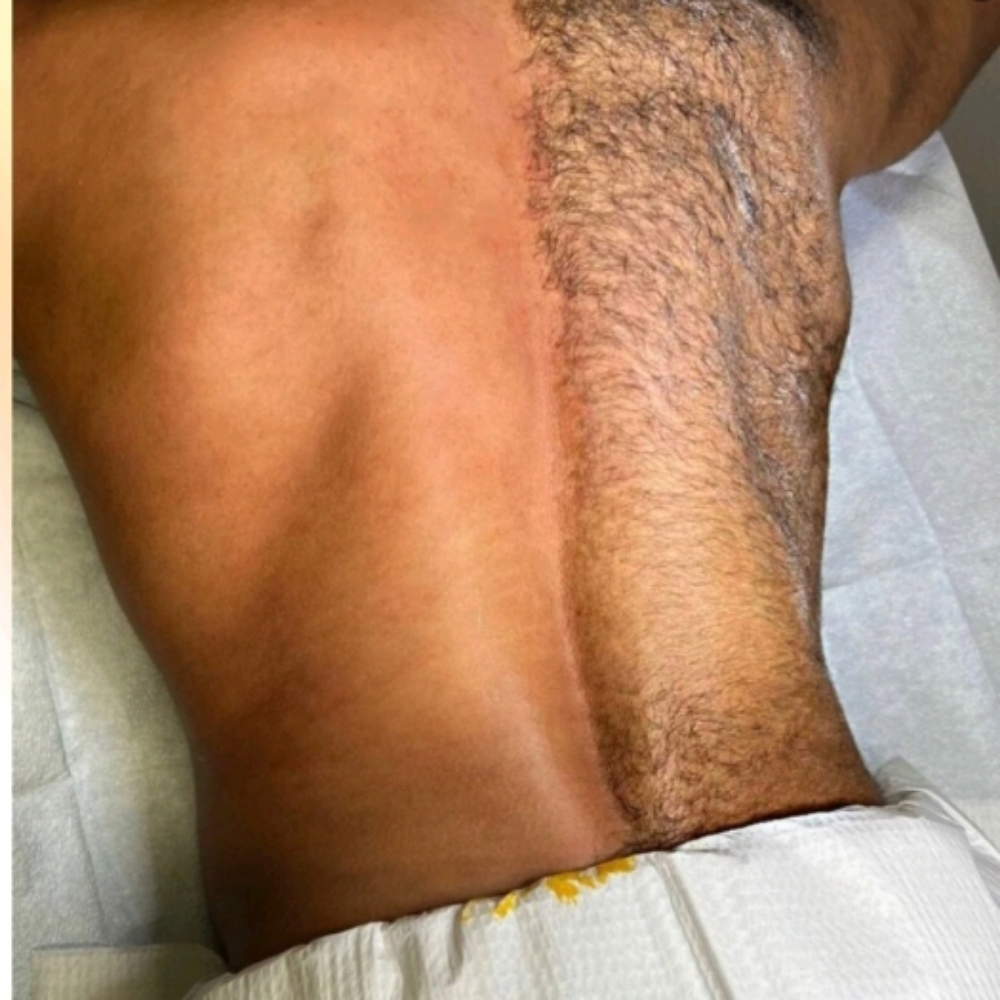 Back Wax at Merritt Aesthetics in Rochester, NY