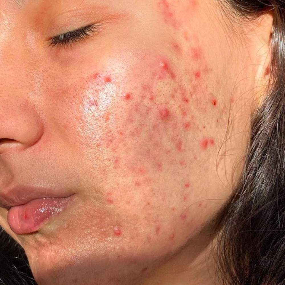 Acne Facial