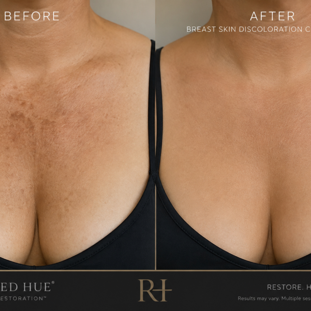 Skin Discoloration at Restored Hue Paramedical Studio in Atlanta, GA
