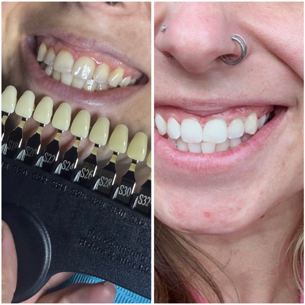 Cosmetic Teeth Whitening at Studio Glow Esthetics By Ashten in Coshocton, OH