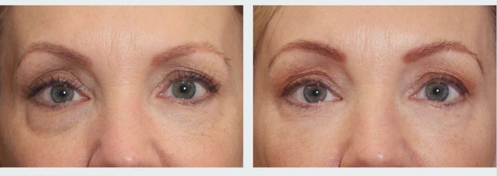 Under Eye Trtmt ( Add On To Facial)