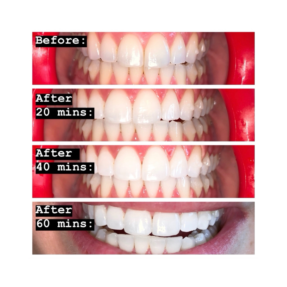 ✧ 1HOUR TEETH WHITENING™ [REG$150]