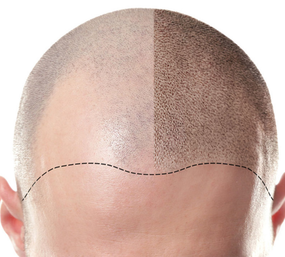 Scalp Micropigmentation SMP