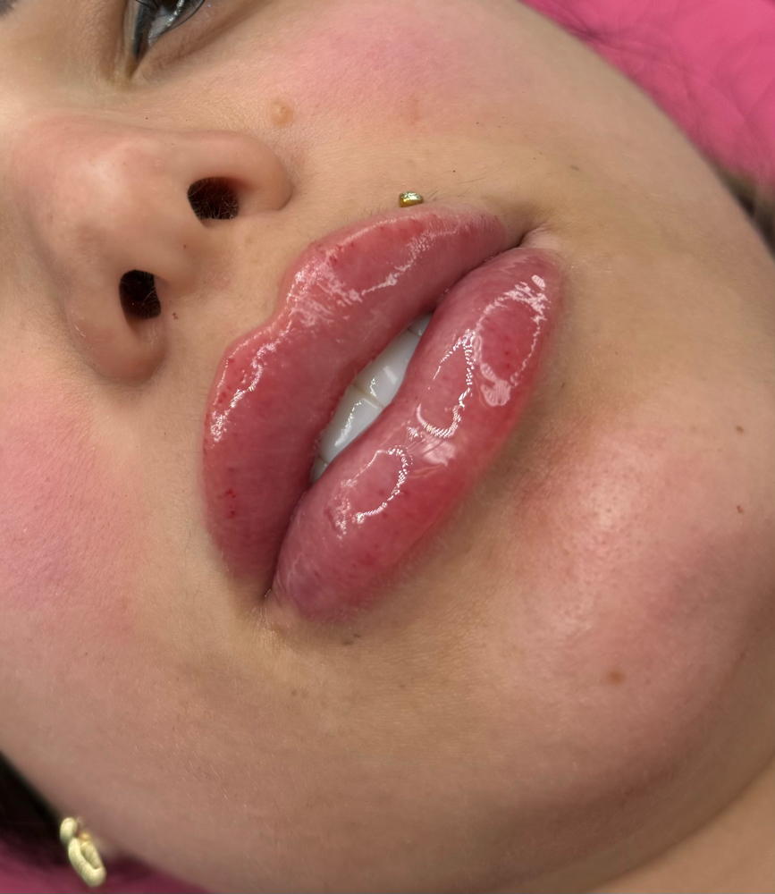Russian Needle-less Lip Filler: 1ml