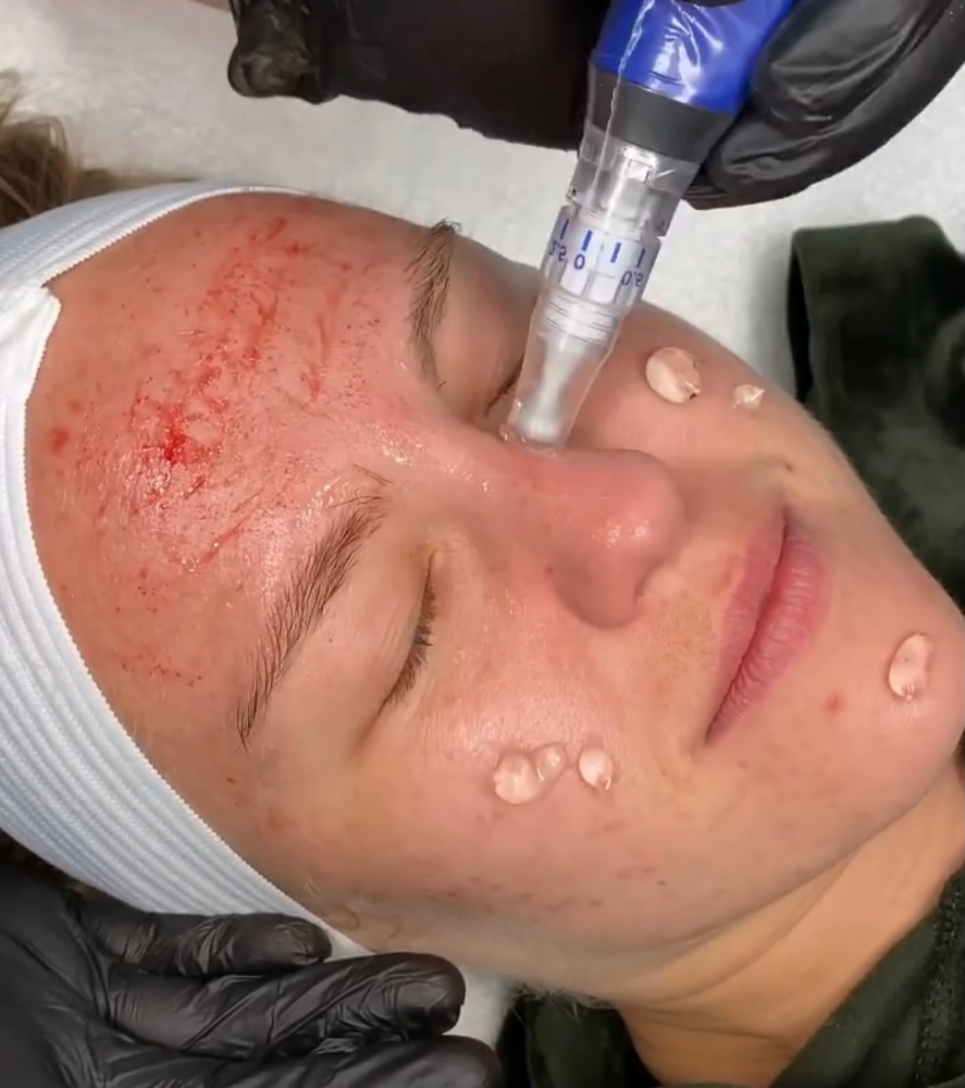 Microneedling Neck Add On