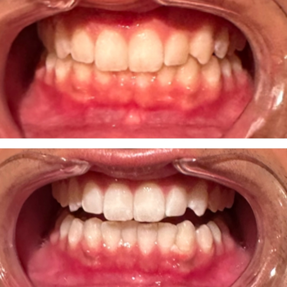 45 min Teeth Whitening