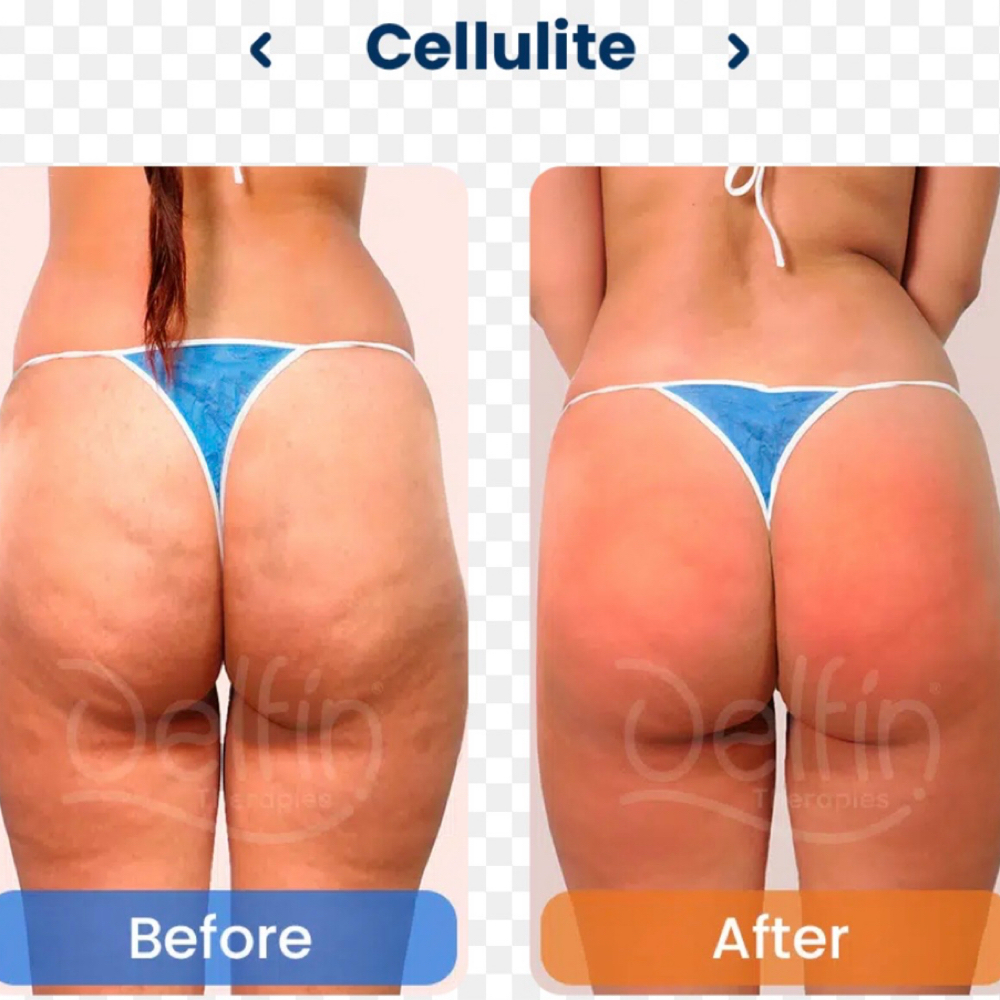 Cellulite Treatment