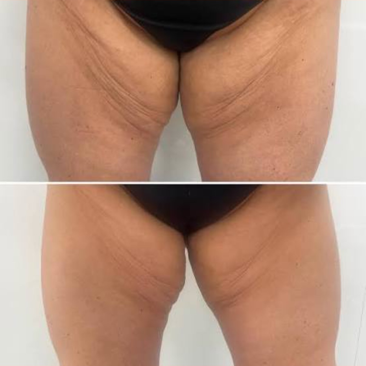 Lipo 360 Inner Thighs at Gold Stone Beauty in mcallen, TX