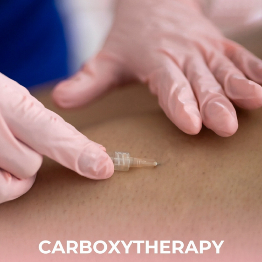Carboxytherapy session at Lymphatic Post-Op Spa in San Diego, CA