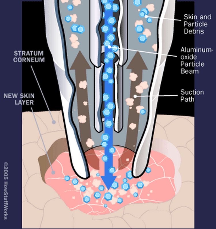 Crystal Microdermabrasion Add On