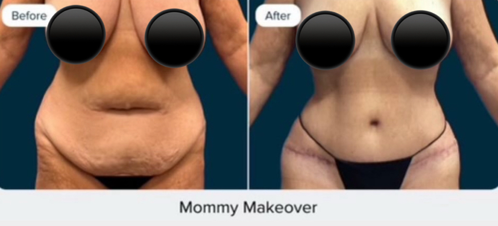 Mommy Makeover Lymph/PostOp Massage