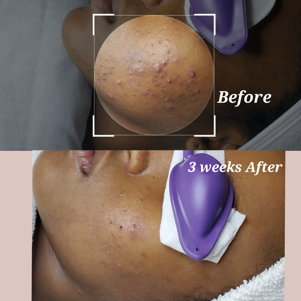 Acne Treatment/Extraction Facail at Kay Spa & Brows in Tukwila, WA