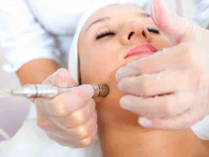 Microdermabrasion Facial