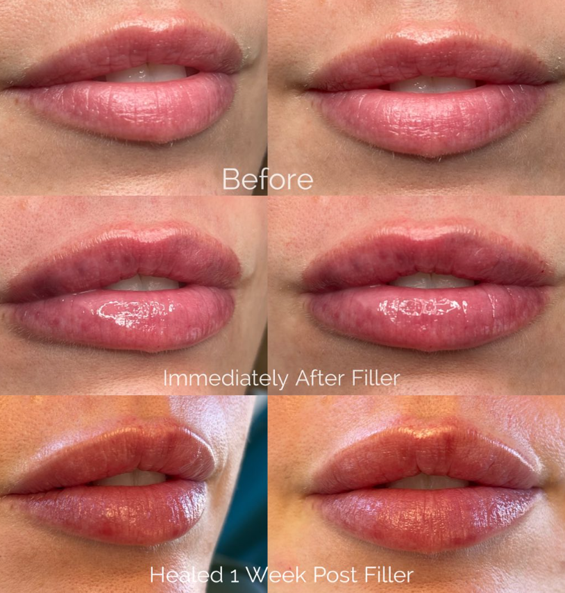 Lip Filler 1/2 Syringe