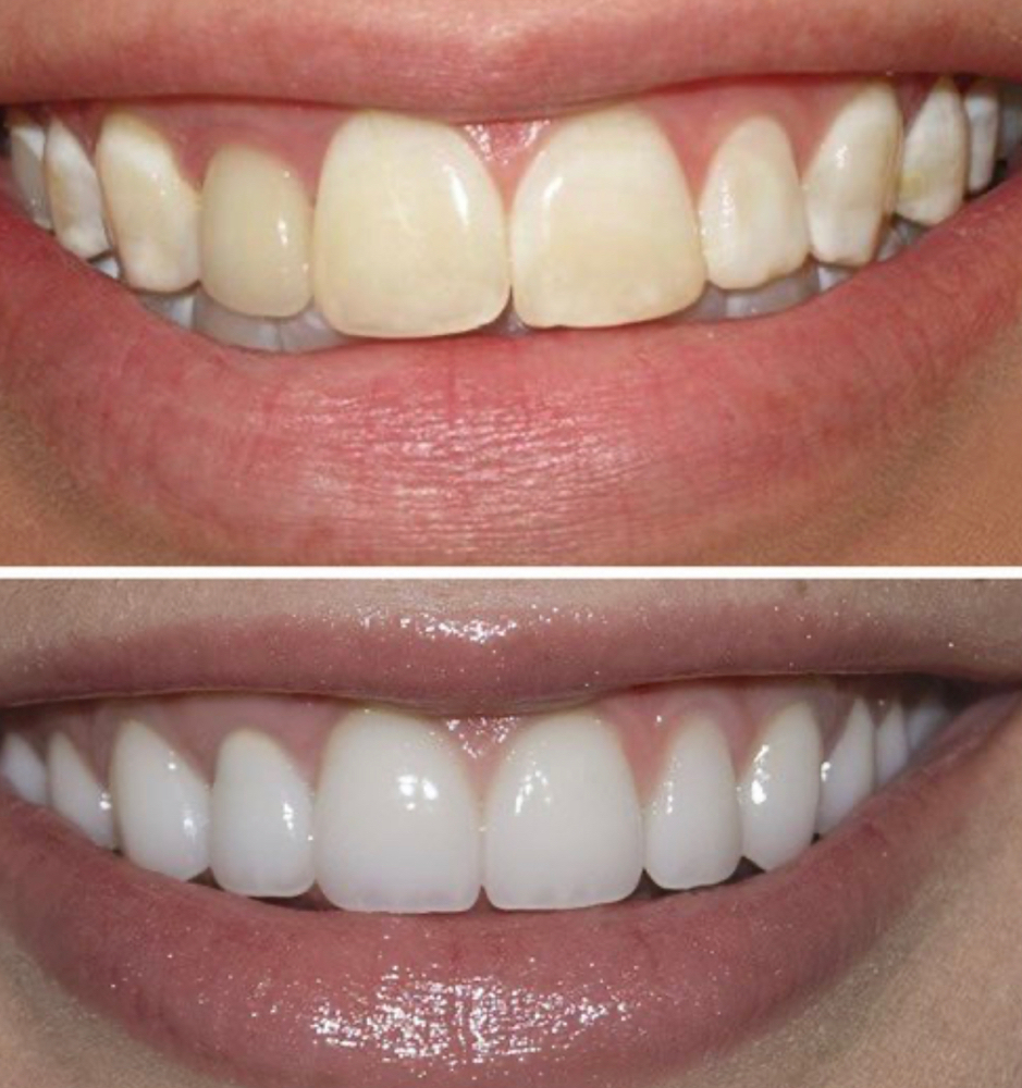 Teeth Whitening –Bright & Confident at Bespoken Beauty in Evansville, IN