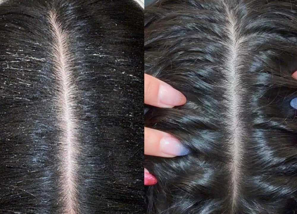 Scalp Treatment