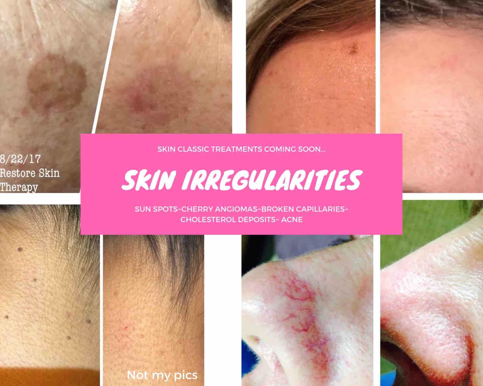 Skin Classic-1 Irregularity Treated