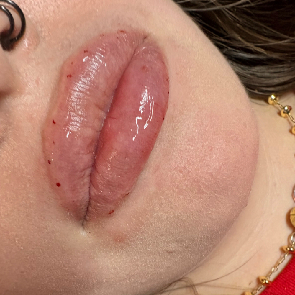 Lip Filler- Full Syringe at Drip & Glow - By Ciera, RN