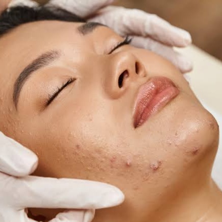 ProClear 60 at SkinFix Pro in Longwood, FL