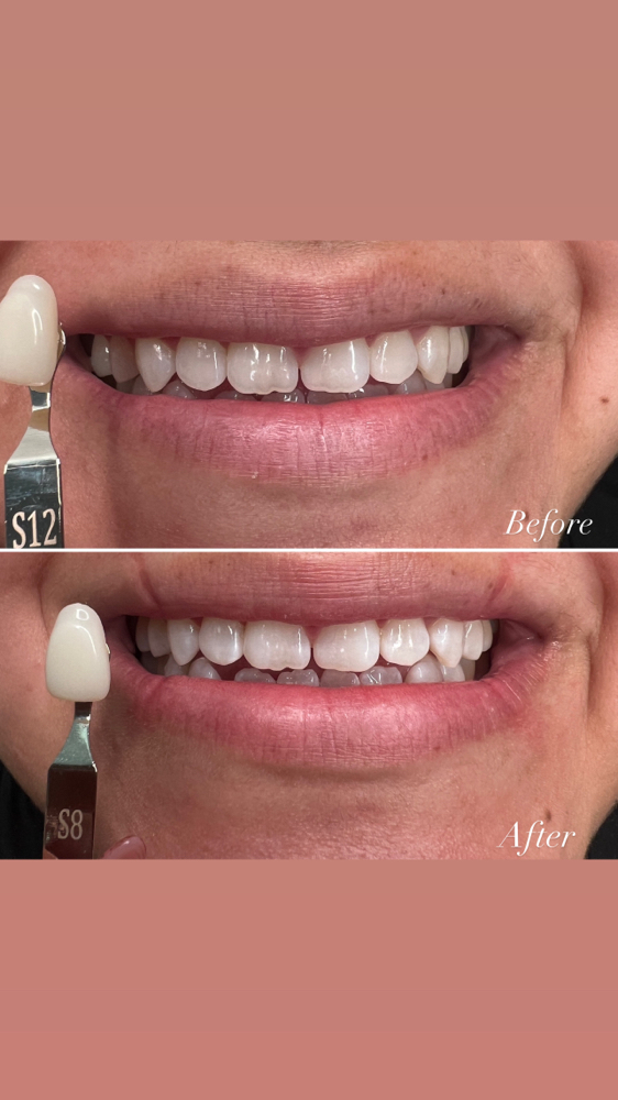 Teeth Whitening Training