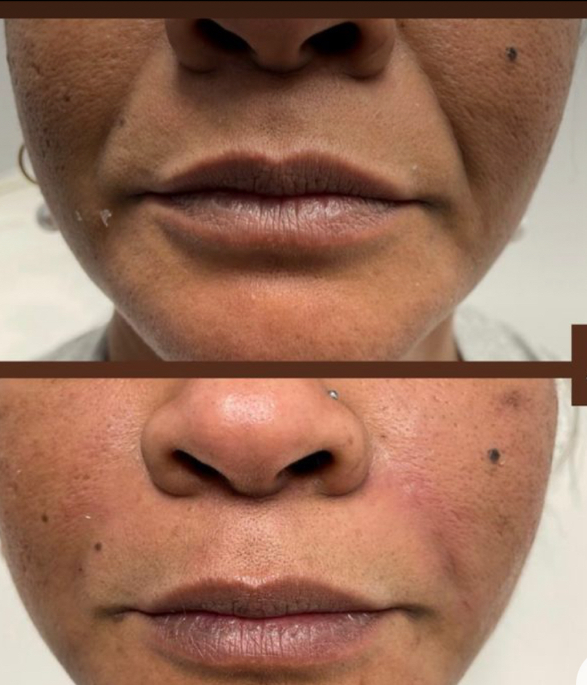 Smile line treatment with fillers