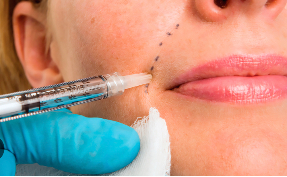 Dermal Fillers