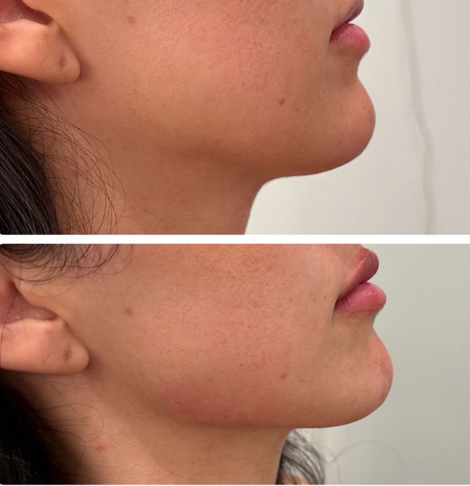 Menton Filler