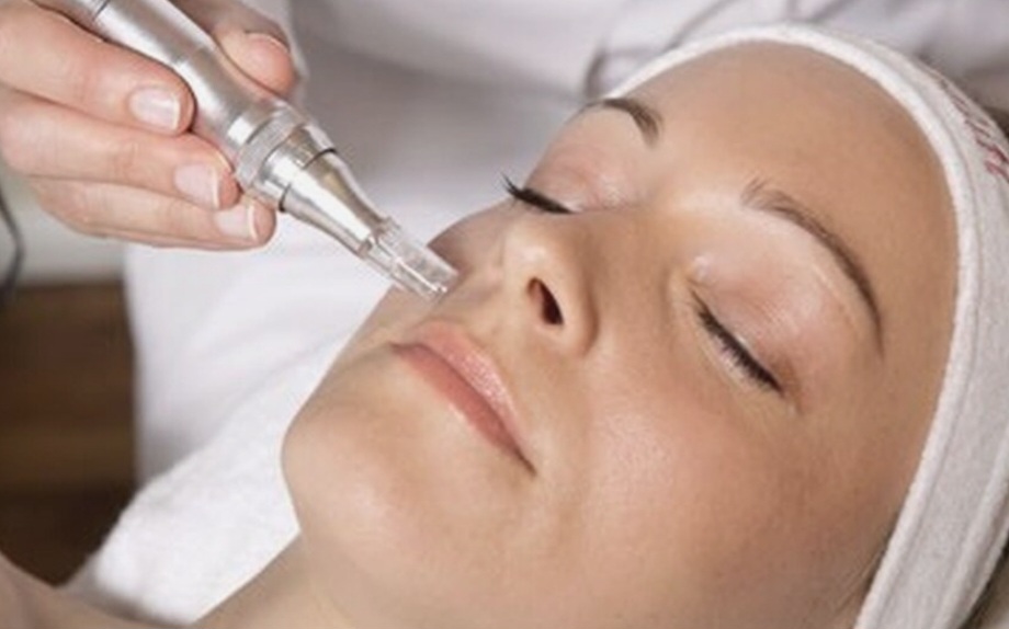 Nano Needling at Renue Spa And Wellness in Joliet, IL